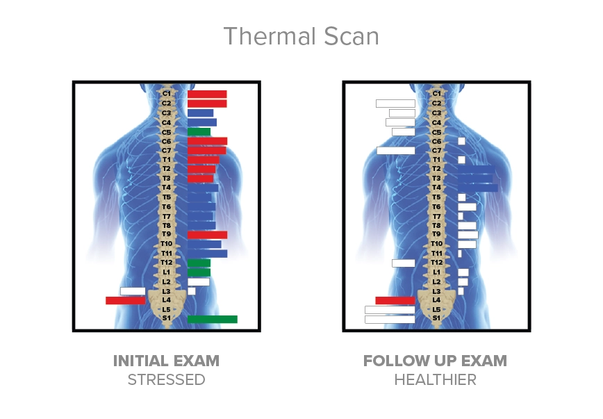 A pediatric CLA INSiGHT thermal scan showing autonomic nervous system regulation and spinal temperature symmetry at The Wellness Path in Knoxville, Maryville and Morristown TN.