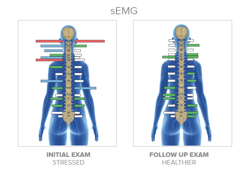 sEMG scan results graph displaying muscle energy and spinal tension patterns for a pediatric, prenatal, or adult patient at The Wellness Path in Knoxville, Maryville, Morristown TN. INSiGHT neurological scanning Knoxville TN.  
